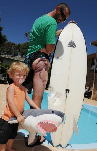 Australian surfer Glen Folkard (R), sporting a massive scare, displays his damaged surf board. ©AFP