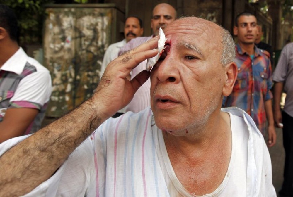 A local resident holds a tissue to a wound near his right eye sustained during clashes with supporters of ousted Egyptian President Mohamed Mursi in central Cairo August 13, 2013. ©REUTERS