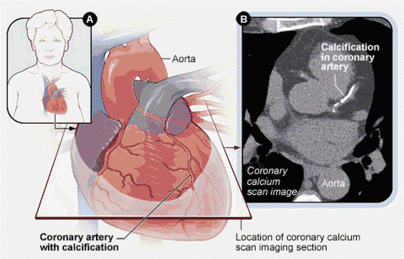 Photo courtesy of coronary-arteries.org