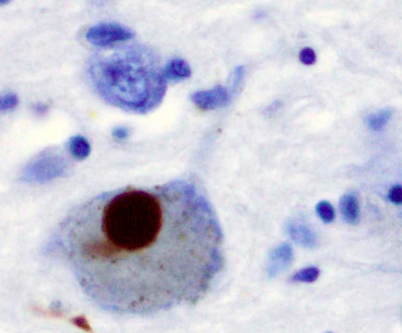 A Lewy body (stained brown) in a brain cell of the substantia nigra in Parkinson's disease. Photo courtesy of en.wikipedia.org
